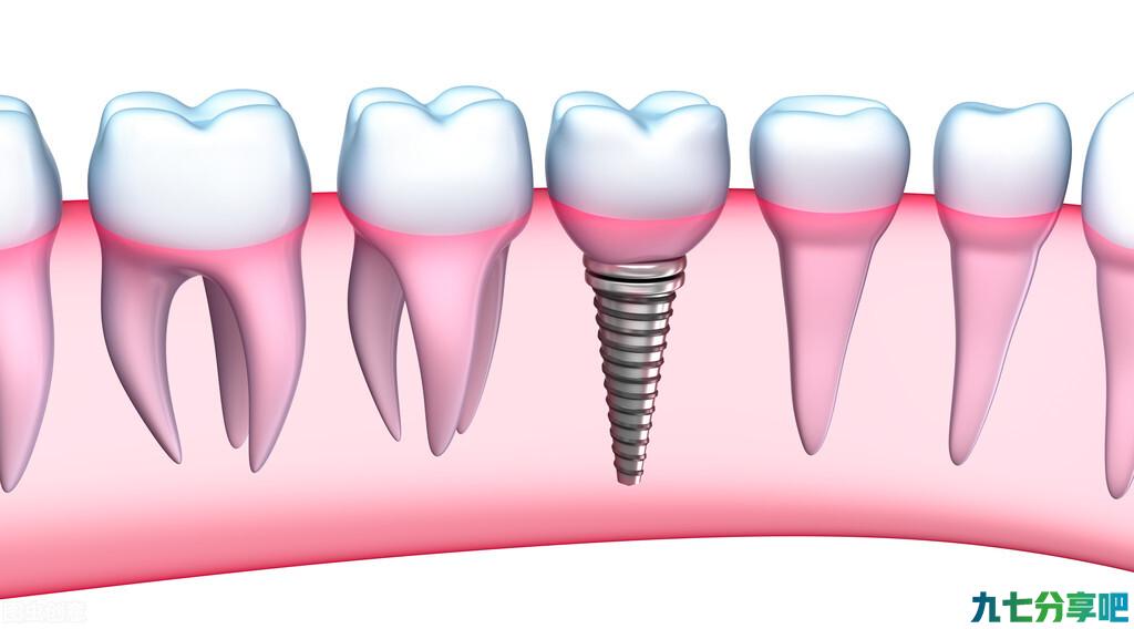 “种植牙”为啥会那么贵？如何低成本护牙？