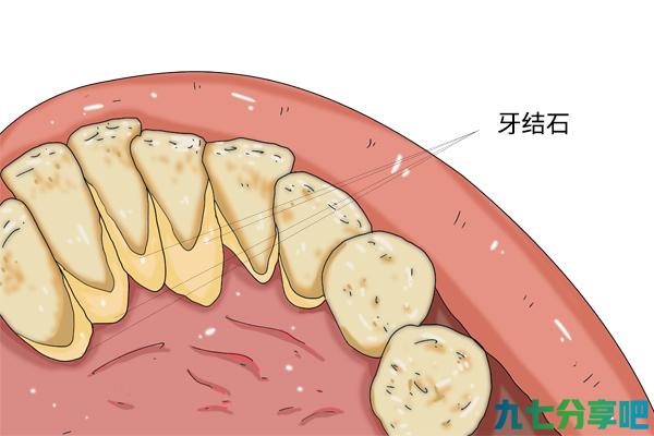 51岁男子，洗牙导致细菌流入心脏！还能放心洗牙吗？