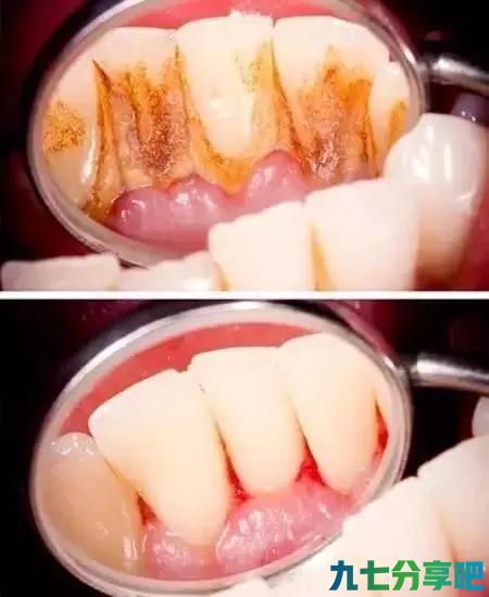 老掉牙其实是一种病，不能洗牙，洗牙了牙齿就松了到底有没有道理
